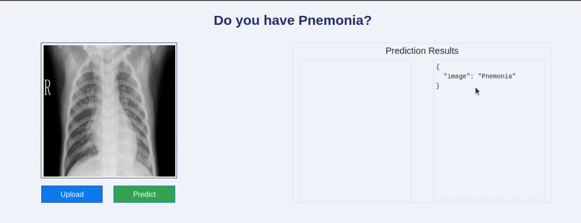Pneumonia prediction